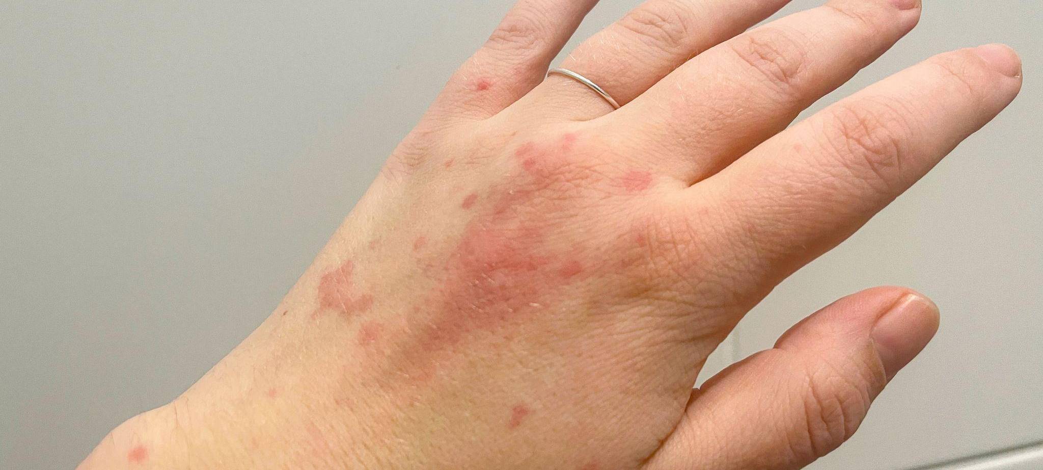 Ein Nesselsucht Ausschlag auf der hand einer Frau